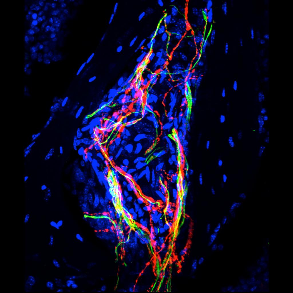 Confocal image of a neuroma-like structure observed in a nonhealed, fractured femur. Sprouted CGRP (red) and NF200 (green) sensory nerve fibers are observed in a trabecular bone &#039;pocket&#039; in the bone marrow (blue) adjacent to the initial fracture site. 