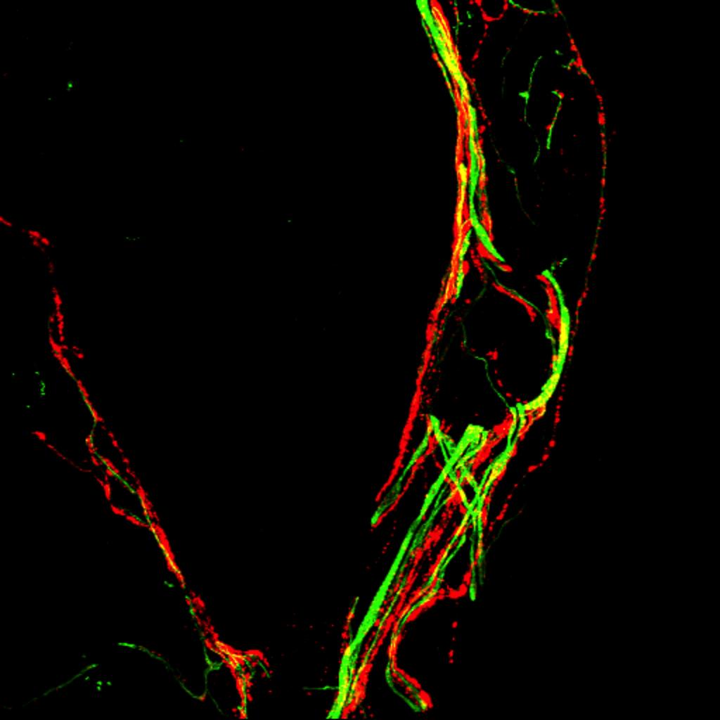 Confocal image of a neuroma-like structure observed in a nonhealed, fractured femur. The structure is comprised of sprouted CGRP (red) and NF200 (green) sensory nerve fibers. These neuroma-like structures are never observed in a normal femur. 