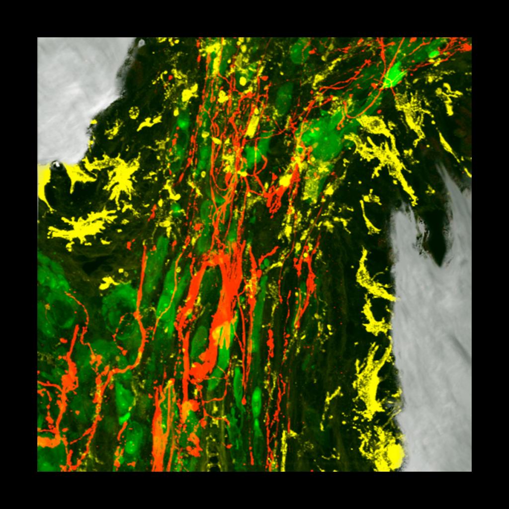 Combined confocal and DIC image of a sensory nerve fibers (red) sprouting into a prostate tumor colony (green). Bone resorbing osteoclasts (yellow) can be seen next to newly formed bone (grey) at the edge of the colony. 