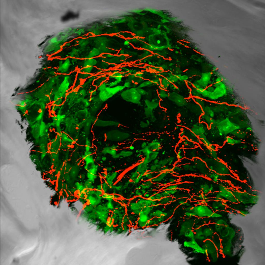 Confocal and DIC image of CGRP sensory nerve fibers (red) sprouting into GFP prostate tumor cells (green). Note how the tumor colony is circumscribed by newly woven bone (grey), a hallmark feature of prostate metastasis in bone.