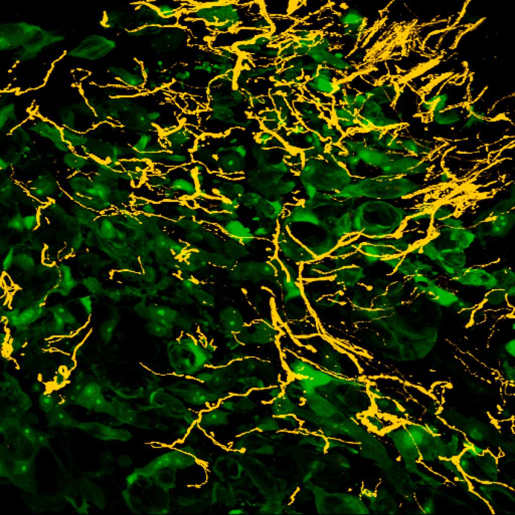 Confocal image of CGRP sensory nerve fibers (yellow) which have sprouted into GFP sarcoma-laden (green) bone marrow. This highly heterogenous nerve growth is never observed in a normal bone. 