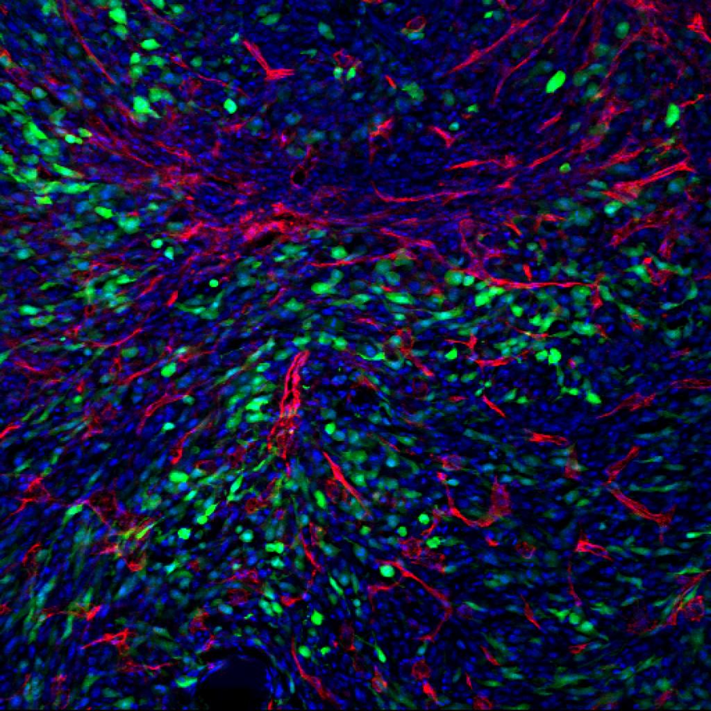 Confocal image illustrating GFP sarcoma tumor cells (green) and CD31 vasculature (red) in the bone marrow (blue).