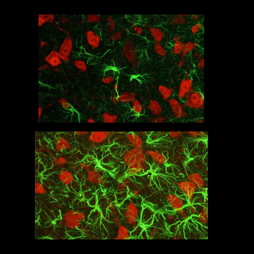 Confocal images from the spinal cord of a normal (top) and sarcoma-injected (bottom) animal. Images are stained with ATF-3, a transcription factor marking cellular damage (red) and NeuN, a marker of neuronal nuclei (green).