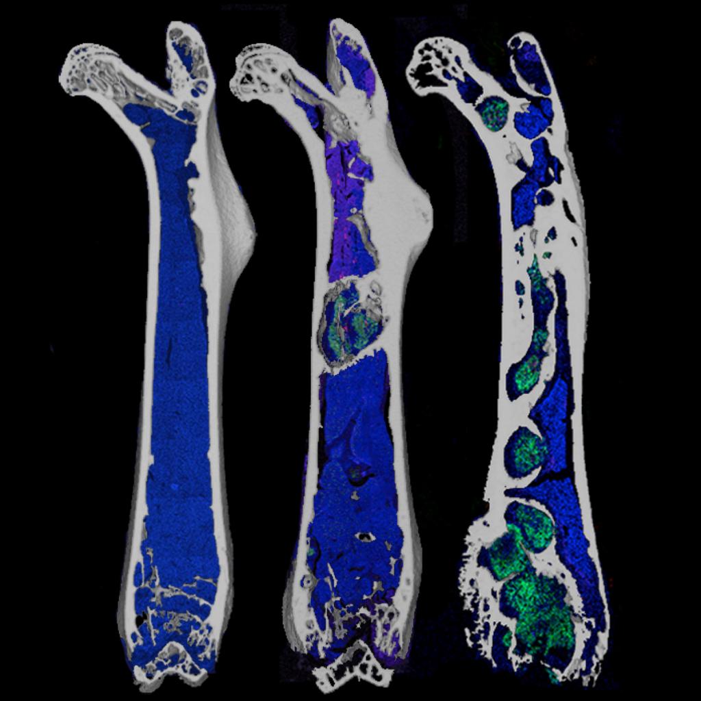 Micro CT images of a femur at early (left), middle (center), and late (right) stages of prostate tumor growth. Each micro CT image was overlaid with a fluorescent image illustrating normal DAPI cell nuclei (blue) and GFP prostate tumor cells (green). Note the increased quantity of prostate tumor colonies with time. 