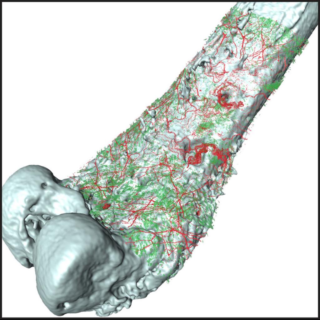 Micro CT image of a femur with a 3D rendering overlay of sprouted CGRP sensory nerve fibers (red) and sarcoma tumor cells (green).